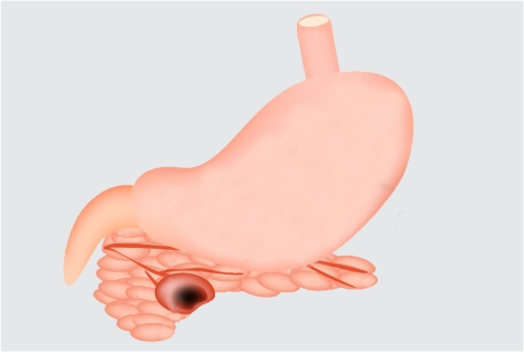 pseudoquiste-pancreatico