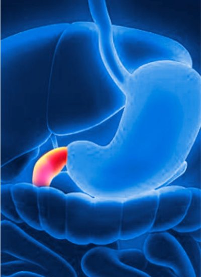 cancer-de-duodeno