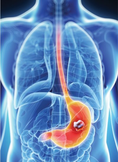 cancer-de-estomago
