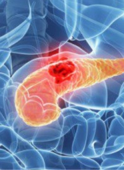 cancer-de-pancreas