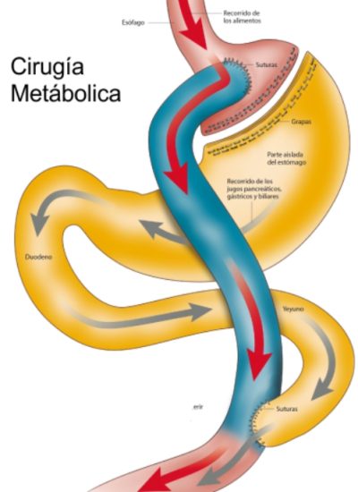 cirugia-metabolica-diabetes