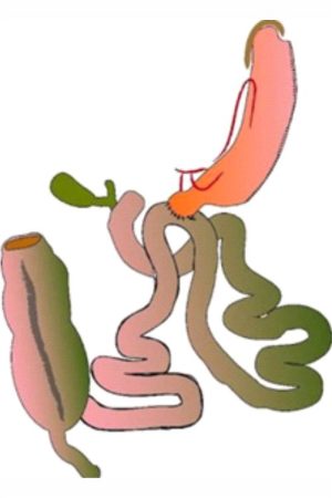 derivacion-bilio-pancreatica-de-una-anastomosis